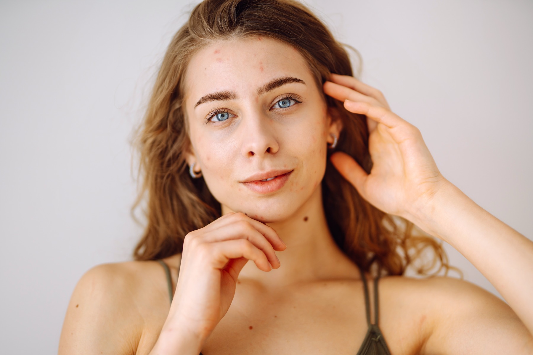 Junge Frau mit lockigen, braunen Haaren und unreiner Haut mit Rötungen und Pickeln im Gesicht.
